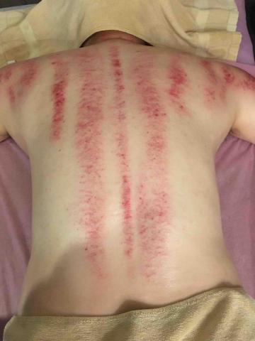 居家到府按摩 -  刮痧