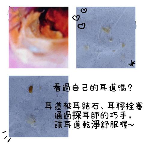 釉spa - 釉SPA-
採耳、耳結石、耳聹栓塞照