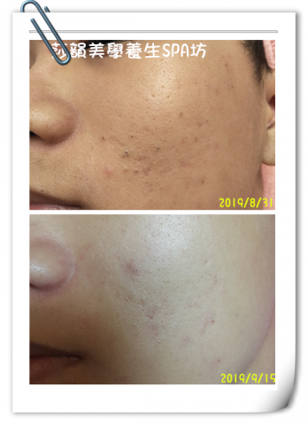 莎韻美學養身spa工作坊 - 無痛粉刺痘痘療程~
無痛不留痕跡的特殊粉刺清法~試過就知道!