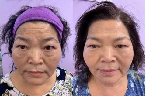 艾茉兒咖啡美妍概念館 - 服務項目 : 一站式抗皺課程，抬頭紋，川字紋，魚尾紋，眼下細紋，提眼角提眉角，髮際線拉提，靜態紋修復。