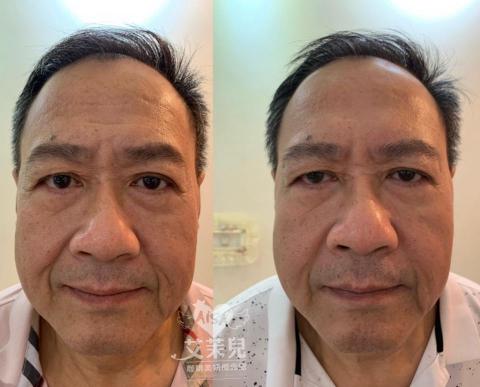 艾茉兒咖啡美妍概念館 - 服務項目 : 一站式抗皺課程，抬頭紋，川字紋，魚尾紋，眼下細紋，提眼角提眉角，髮際線拉提。