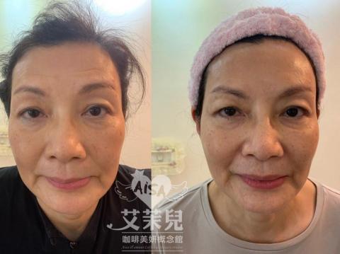 艾茉兒咖啡美妍概念館 - 服務項目 : 一站式抗皺課程，抬頭紋，川字紋，魚尾紋，眼下細紋，提眼角提眉角，髮際線拉提，小V臉線雕拉提。