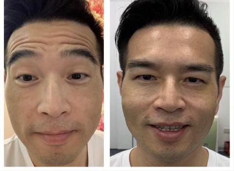 艾茉兒咖啡美妍概念館 - 服務項目 : 一站式抗皺課程，抬頭紋，川字紋，魚尾紋，眼下細紋，提眼角提眉角，髮際線拉提。