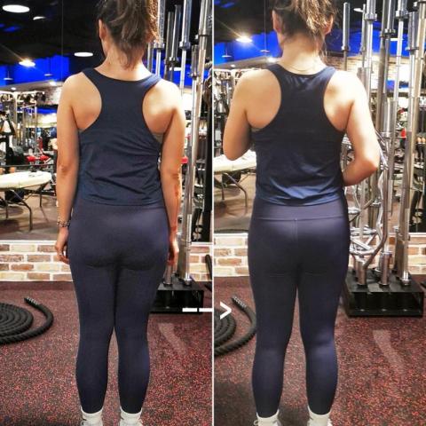 黎震遐 - 臀型改善