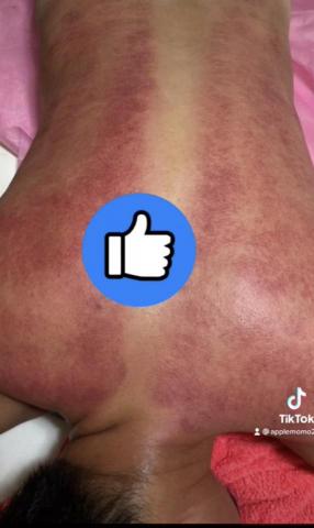 華華個人指油壓 - 刮痧儀舒壓