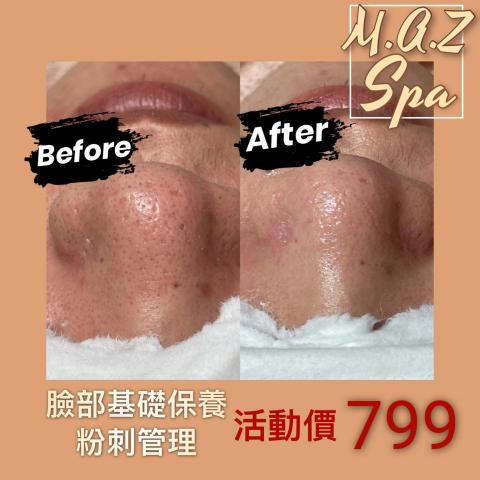 M.A.Z美學Spa館 - 毛孔管理，操作前後對比圖