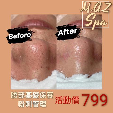 M.A.Z 美學Spa館 - 粉刺管理