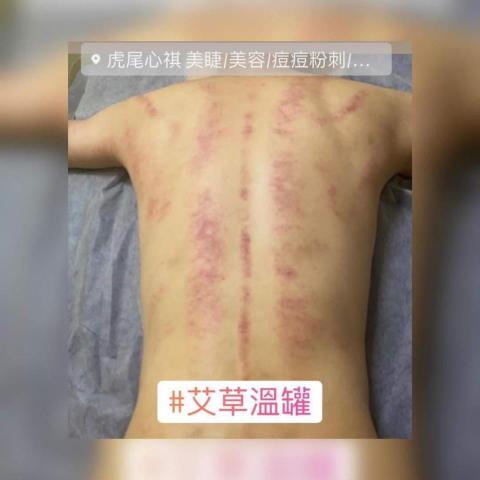 虎尾心祺複合式美業 -  雲林虎尾溫罐 雲林虎尾無痛引痧 雲林虎尾刮痧