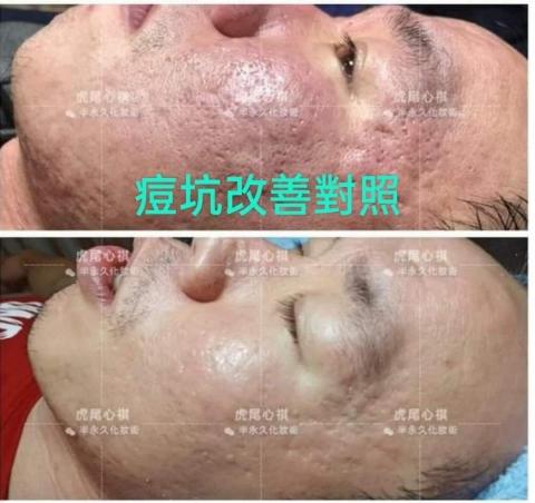 虎尾心祺複合式美業 - 痘痘 問題肌  痘疤 改善