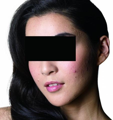 Anne - 人物膚質精修（前）