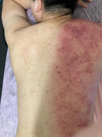 華華個人指油壓 - 刮痧儀對比照