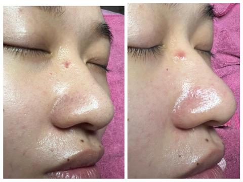 美苙婕美學館桃園店 - 無痛清粉刺