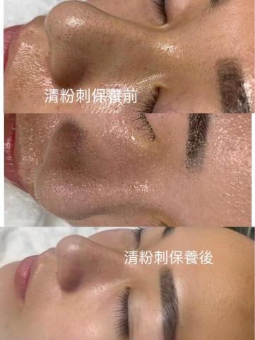 王宥尹美容Spa - 專業無痛清粉刺