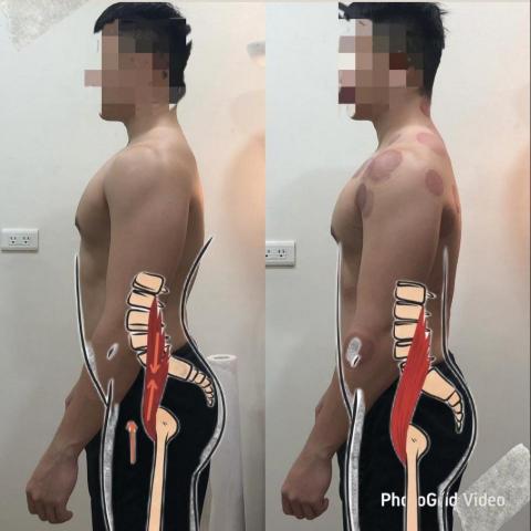 小胖運動按摩 - 骨盆前傾調整