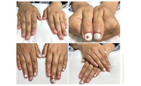 媳婦美甲 - 作品3-甲片跟紅豆大小差不多的客人，但持續按時做指甲後，指甲慢慢變好看。