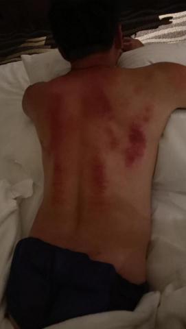 DB0110行動美學寵褓 - 背部撥筋刮痧處理