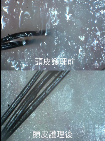 三重做臉寶麗萊美容Spa - 清粉刺前後對比 三重做臉寶麗萊美容Spa - 清粉刺前後對比