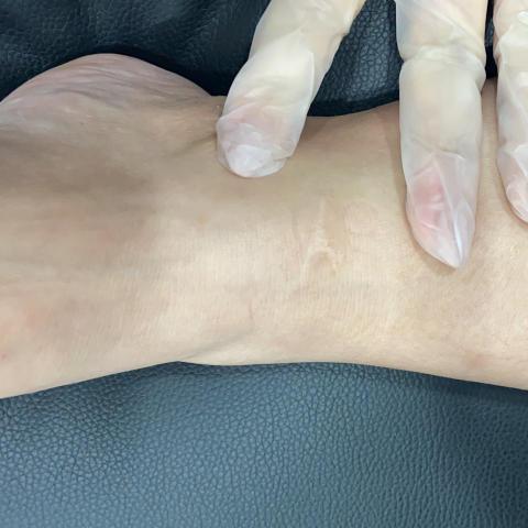 蘇小姐 - 膚色重建服務（疤痕遮蓋）