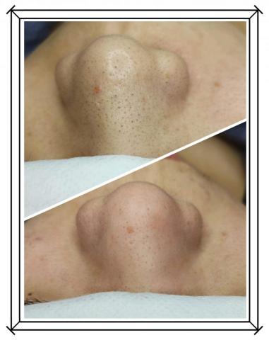 艾眉殿時尚美學（店長：梓珊） - 清粉刺：
臉上的黑頭粉刺讓你煩惱嗎？
我們可以幫您把你的毛細孔做一個大掃除喔！
讓你每一個毛細孔都可以重新呼吸喔～