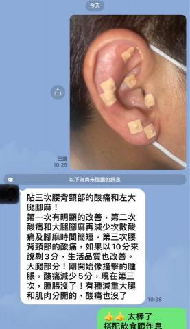 小野運動按摩/耳穴貼壓 - 