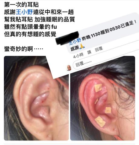 小野運動按摩/耳穴貼壓 - 