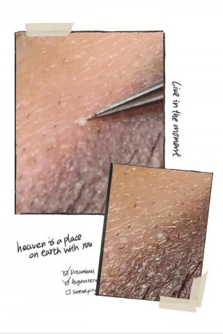 Her spa 肌膚美學 - 脂肪粒