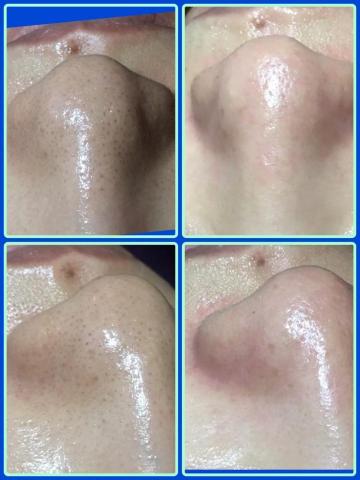 Her spa 肌膚美學 - 黑頭粉刺