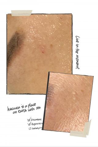 Her spa 肌膚美學 - 脂肪粒