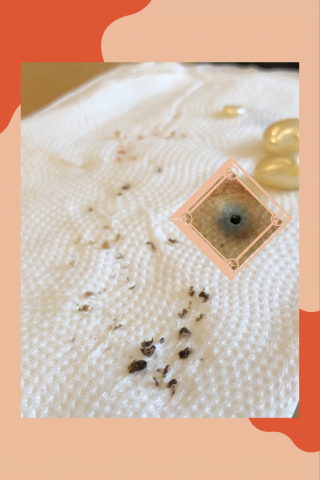 Her spa 肌膚美學 - 客人誤以為的痣&hellip;