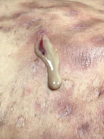 Her spa 肌膚美學 - 背部的囊瘡與結節