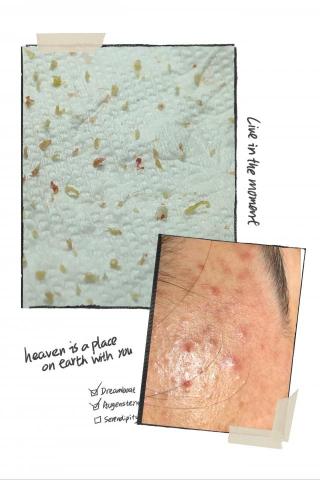 Her spa 肌膚美學 - 額頭內胞粉刺