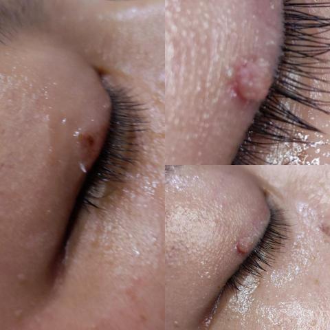 May 睫手作 - 除疣，除痣