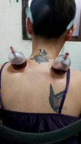 小趙 - 幫女客戶放血，強化體質