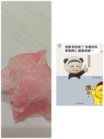 曹鈞晴 - 一個孩子前來做拔粉刺，皮膚很乾又有點冬季過敏、鼻頭滿滿的粉刺，
鼻頭粉刺讓她很困擾，也相對沒自信，當在除去粉刺面膜的時候看到一根根粉刺都上來真的是太驚人了！
這個孩子看到了自己的粉刺清除了這麼多感到很開心，說她之前有用過類似的東西結果沒效果，今天的成果讓她很開心，也再約好下次清除的時間了???
還興奮的包了套呢～

幫助人們變漂亮讓我很有成就感❤️
工作室麻豆募集中
前30會享有優惠喔❤