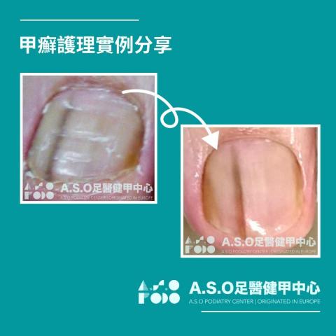 阿瘦足醫健甲中心 - 