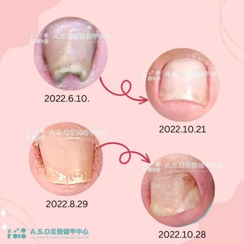 阿瘦足醫健甲中心 - 