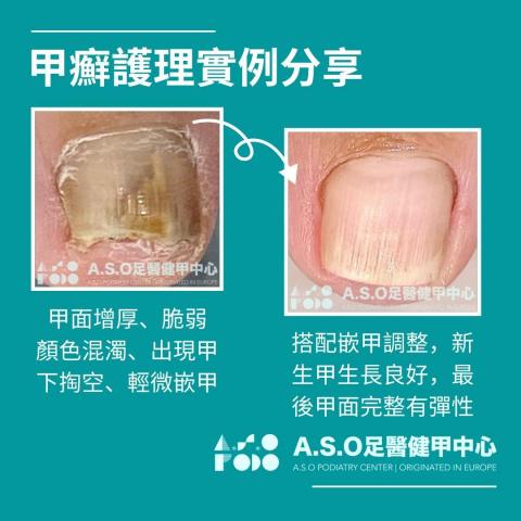 阿瘦足醫健甲中心 - 