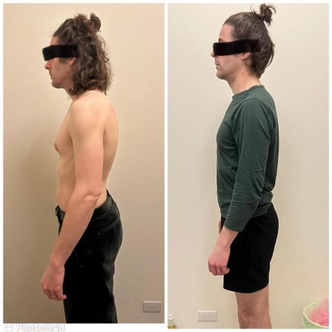 terry - 長年駝背，兩個禮拜調整四次的成果