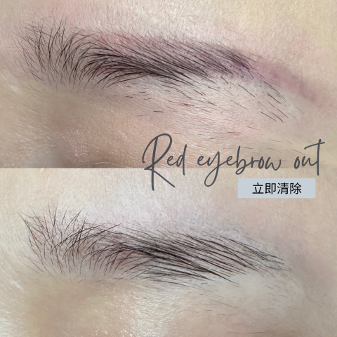 MILLER BEAUTY | 米樂美學苑 - 紅眉除色案例