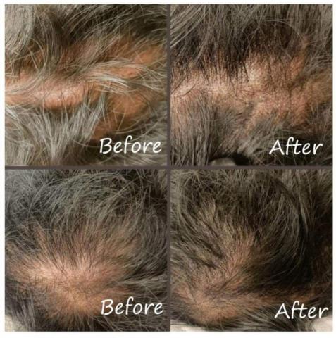 The Metamorphosis Studio  - Smo毛囊仿真，做一次的效果。約三次含補色就不再禿頭了！