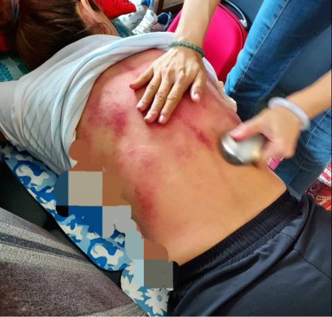 氣電融合摧經絡術 - 背部濕氣重