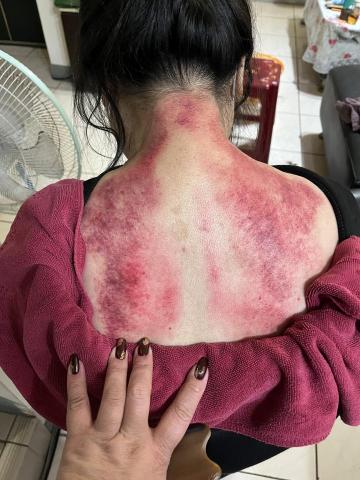 陳韋伶 - 這位客人覺得肩頸痠痛、緊繃、小感冒，刮一刮之後整個人變很輕鬆，晚上也好睡覺