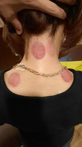 勛師傅 - 頸部痠痛拔罐