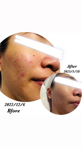 劉嘉欣 - 痘痘肌膚護理