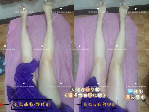 彤美顏，創造您的美麗童顏（蘆洲店） - 局部雕塑（改善大腿鬆弛與多肉）