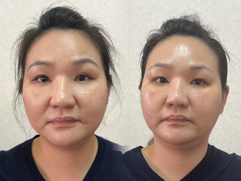 JZ美學苑 - 法令紋變淡，皮膚如同燈泡般的發亮