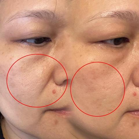 JZ美學苑 - 毛細孔明顯改善