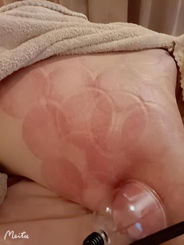 蘿莎美學 - 『DL肌肉平衡儀』
通經活絡、活血止痛、行氣消腫、袪風濕等效果。
研究顯示，使用後放鬆局部的肌肉、筋膜，因此能改善因慢性肌肉緊繃僵硬所造成的疼痛與關節活動障礙。
使用完會有一顆一顆的紅紫色塊皆屬於自然反應（至少維持三天以上，看個人代謝反應而不同）
不同的身體狀況使用完會呈現不同的皮膚顏色：
灰白色	氣血不足，體質較虛
淡粉色	氣血循環良好
艷紅色	熱証
紫黯色	氣血循環欠佳，血瘀
