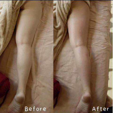 蘿莎美學 - G5體雕儀利用高速震盪的原理，重力加速破壞皮下組織的脂肪，讓脂肪分解與代謝，脂肪細胞壁被破壞之後就會隨著淋巴與血液代謝掉，搭配精油幫助血液循環，同時排毒
根據每個客人脂肪囤積的點不同，可以客製部位，甚至深層乳酸堆積的肩頸腰背、富貴包也可以進行G5體雕
有客人分享已經落枕很久的病症，怎麼舒壓，或是整脊開背都沒有用，竟然是用了G5體雕儀幫助他的陳年落枕給解決了！

進行G5體雕儀過後補充蛋白質或是膠原