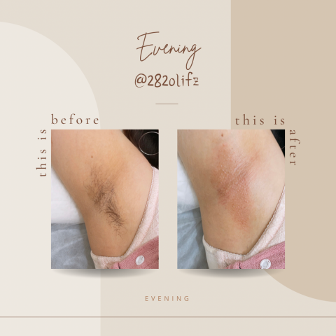 夕/新竹熱蠟除毛 - 